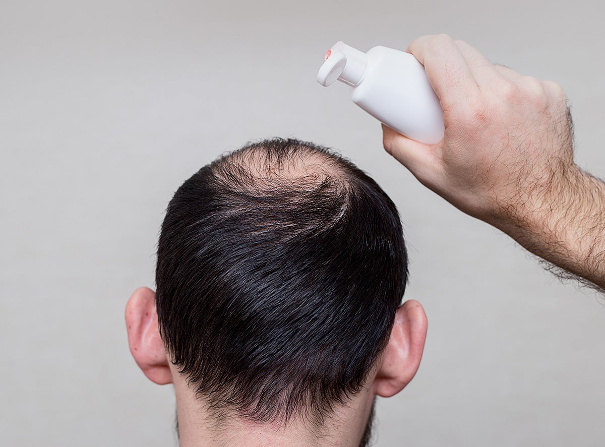 Лечение выпадения волос народными средствами