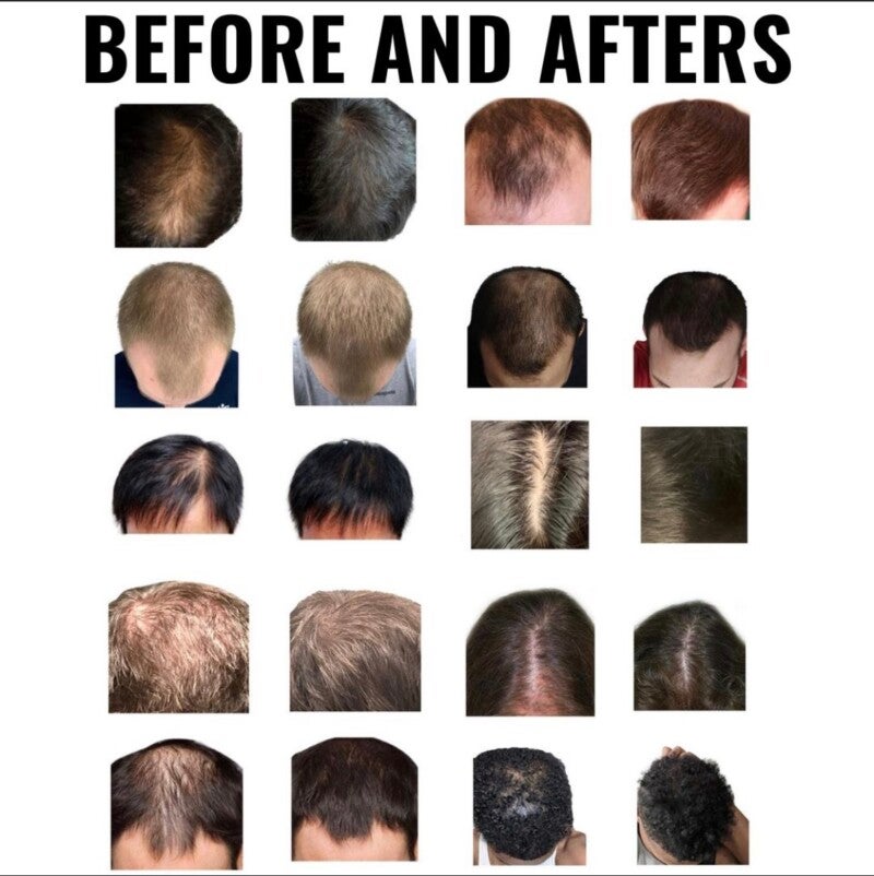 Stop Hair Loss by Eating These 10 DHT Blocking foods 2020 Update   Almonds to block DHT bananas to block DHT block DHT and more  It Really  Works Vitamins Naturally Prevent Hair Loss blog